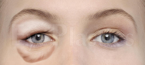 Cosmetic eyelid surgery, Blepharoplasty, Eyelift